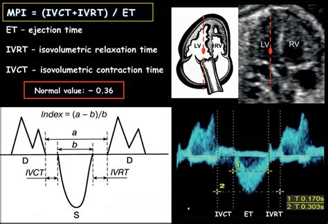 lv mpi calculator|Fetal Cardiac Function: Myocardial Performance Index .